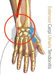 Extensor Carpi Ulnaris Tendonitis