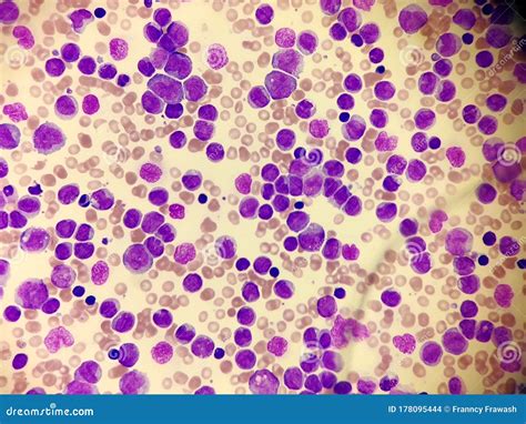 Acute Leukemia Blood Smear