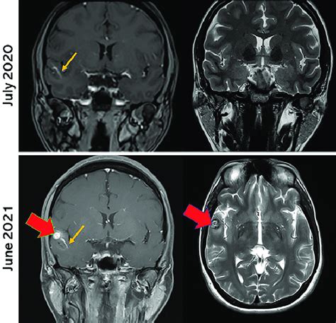 Upper: Patient underwent a pituitary dedicated MRI due to mildly ...