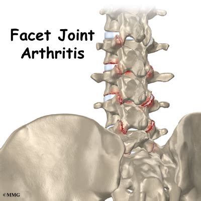 Lumbar Facet Joint Arthritis | Orthogate