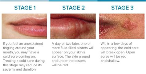 Cold sore stages identification and treatment – Artofit