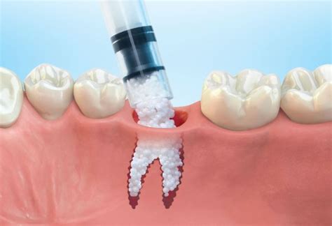 Bone Grafting - Chapel Gate Dental