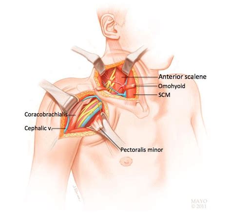 Brachial Plexus Injuries - OrthoInfo - AAOS