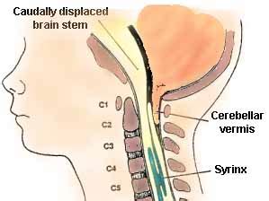 Chiari Malformations » Lillian S. Wells Department of Neurosurgery at ...