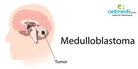 Medulloblastoma: Causes, Symptoms And Treatment