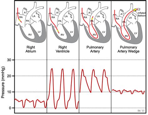 CV Physiology | Pulmonary Capillary Wedge Pressure