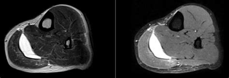 Calf Strain Mri