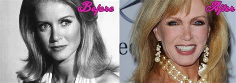 Donna Mills Before and After Surgery Pics | Surgery Stars