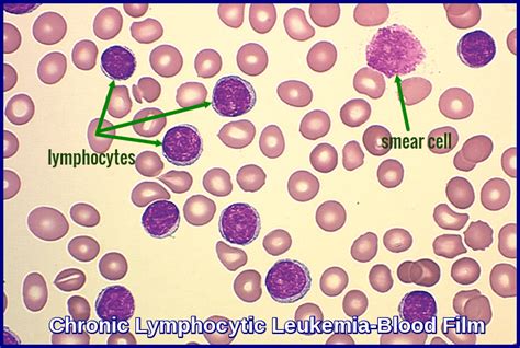 Chronic Lymphocytic Leukemia - Ask Hematologist | Understand Hematology