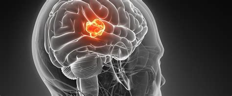 Pacientes con glioblastoma | FEMEXER