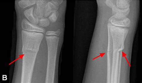 Greenstick Fracture - Causes, Healing Time, Treatment