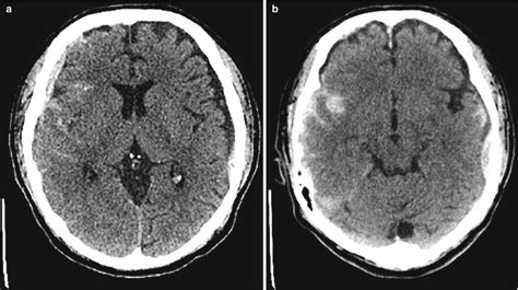 Fig. 7.2, [(a, b) Axial non-contrast CT-scan,...]. - Diseases of the ...