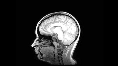 My Brain - MRI Scan Result Images - YouTube