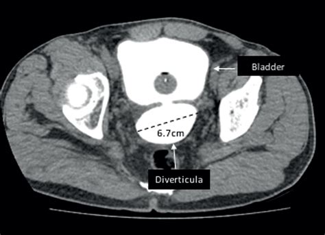 SciELO - Brasil - The role of bladder diverticula in the prevalence of ...