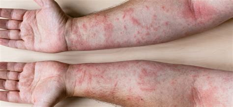 What are the causes of an itchy rash on the body? – Healthy Food Near Me