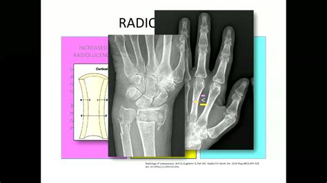 Severe Osteoporosis X Ray