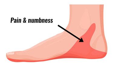 Inside Ankle Pain (Medial) - Symptoms, Causes, Treatment & Rehab