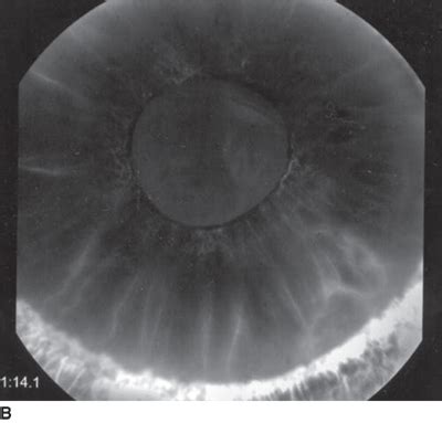 25 Neovascular Glaucoma | Ento Key