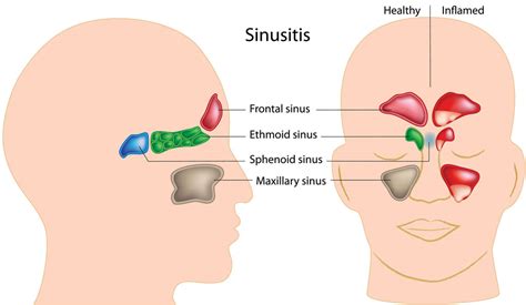 Sinus Infections - Otolaryngology Specialists of North Texas