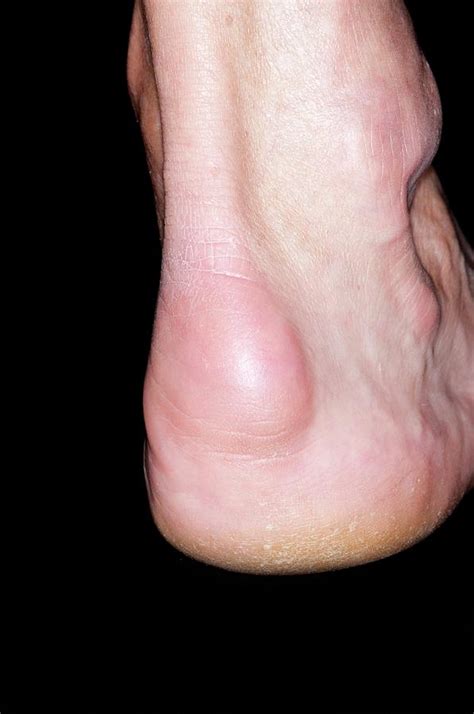 Bursitis Of The Heel Of The Foot Photograph by Dr P. Marazzi/science ...