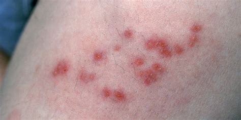 Shingles May Raise Later Stroke, Heart Attack Risk