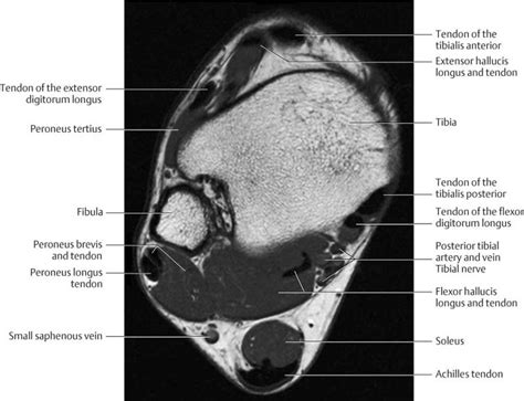 Mri Plantar Foot Anatomy Muscles