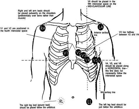 Holter Monitor 5 Lead Placement Diagram - Diagram For You