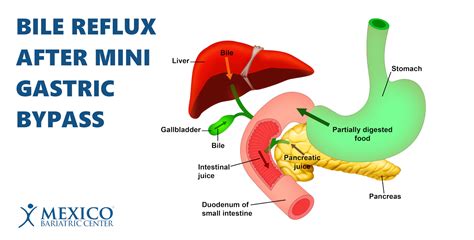 Bile Reflux: Symptoms, Treatment, Causes What It Is, 52% OFF