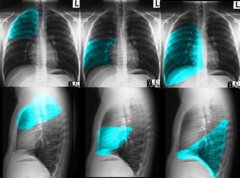 Chest X Ray Anatomy Lung Lobes And Fissures In The Right Lung There ...