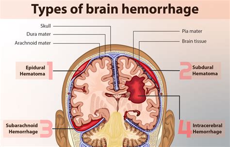 What is the Difference Between Intracerebral Hemorrhage and ...