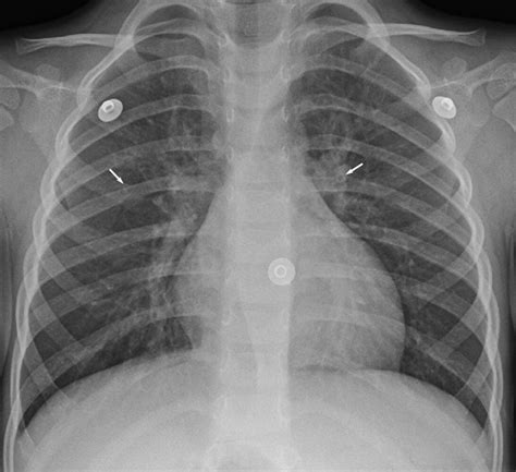 Chest X Ray Bronchitis Vs Pneumonia