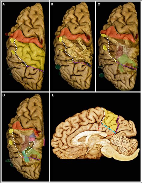 Superior Parietal Lobule Approach