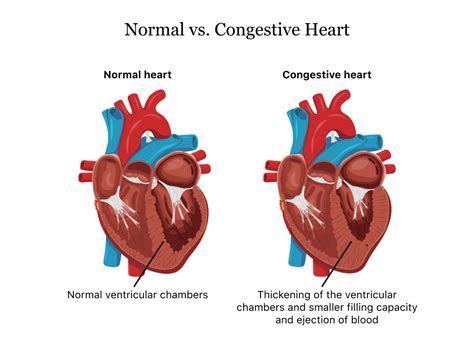 Heart failure/Congestive heart failure(CHF)