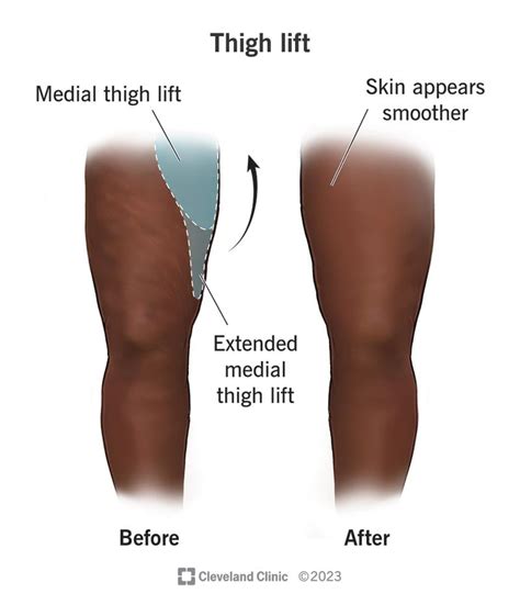 Thigh Lift (Thighplasty): Types, Surgery, Recovery & Scars