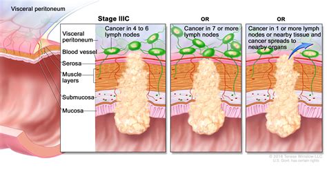 Colorectal Cancer Treatment