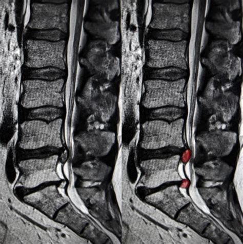 How to Read the MRI for a Herniated Disc and 5 Treatment Options