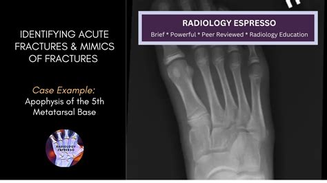 IDENTIFYING ACUTE FRACTURES, MIMICS OF FRACTURES: Case Example ...