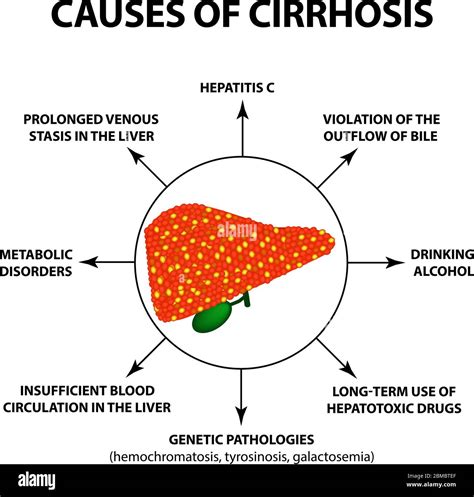 Causes of cirrhosis. Infographics. Vector illustration on isolated ...