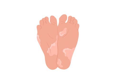 What Causes Peeling Feet | Why is the Skin Peeling on my Feet | Buoy