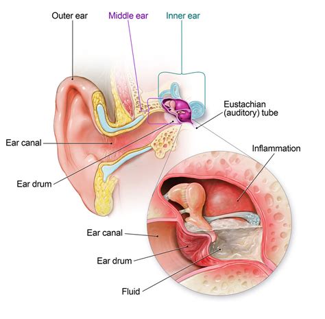 Ear Infections - Pediatrics Northwest