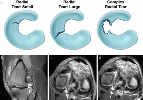 ISAKOS classification of meniscal tears—illustration on 2D and 3D ...