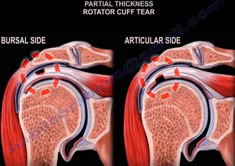 Rotator Cuff Tear Classification — OrthopaedicPrinciples.com