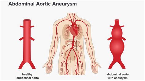 Aneurysm – Types, Symptoms & Causes – Page 3 – Entirely Health