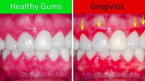 How to Have Healthy Gums - Smart Health Shop