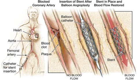 Do angioplasties and coronary stenting improve symptoms in patients ...