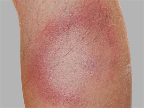 Lyme disease rash: Symptoms, stages, and identification | Lyme disease ...