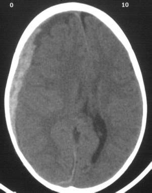 Subdural Hematoma: Background, Pathophysiology, Etiology