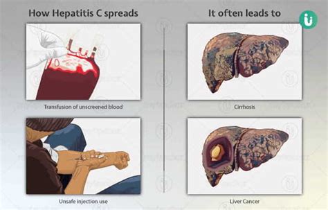 Hepatitis C - GlynnArafat