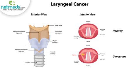 Laryngeal Cancer: Causes, Symptoms And Treatment