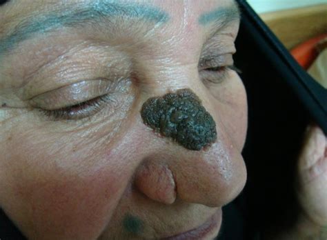 Seborrheic Keratosis - Causes, Symptoms, Home Treatment